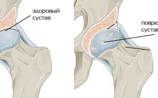 Симптомы и эффективное лечение коксартроза тазобедренного сустава 2 степени