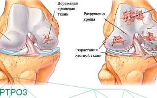 Что такое артроз коленного сустава, и как его лечить?