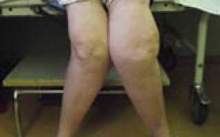 Типы болезней коленного сустава и их причины, диагностика и лечение