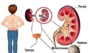 Самые эффективные способы по предотвращению появления камней в почках