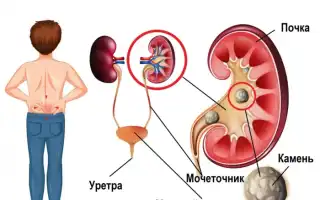 Самые эффективные способы по предотвращению появления камней в почках