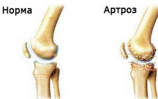 Хондропротекторы для суставов