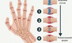 Почему болят суставы на пальцах рук, и как избавиться от боли