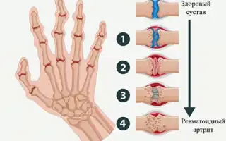 Почему болят суставы на пальцах рук, и как избавиться от боли