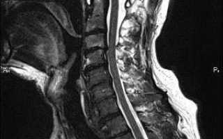 Причины, симптомы и лечение грыжи шейного отдела позвоночника