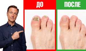 Простое и эффективное лечение грибка ногтей ног