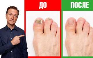 Простое и эффективное лечение грибка ногтей ног