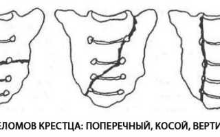 Как не остаться прикованным к постели при переломе крестца?