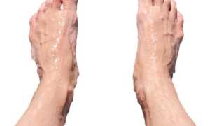 Гипергидроз – стоп! Что это за заболевание и опасно ли оно