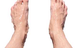 Гипергидроз – стоп! Что это за заболевание и опасно ли оно