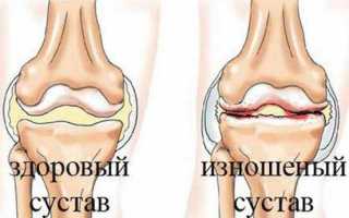 Основные причины появления и способы избавления от хруста в суставах