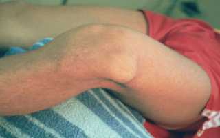 Артралгия: типы, причины и лечение