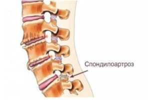 Спондилоартроз шейного отдела позвоночника