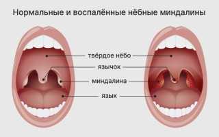 Чем можно лечить горло на ранних сроках беременности