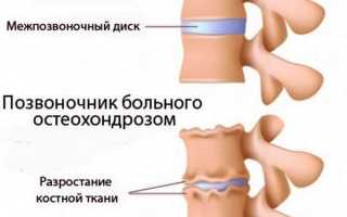 Лечебная физкультура при остеохондрозе для тех, кто нуждается в помощи