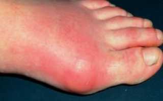 Симптомы и лечение подагрического артрита