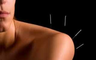Иглоукалывание — польза и вред курсовых сеансов