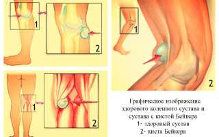 Как лечить кисту Беккера под коленом?
