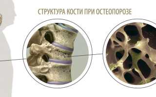 Профилактика остеопороза, как сохранить радость движения на долгие годы