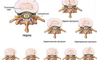 Протрузия межпозвоночных дисков — проблема на пути к грыже