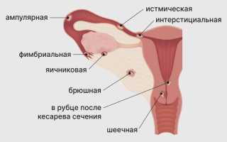 Симптомы внематочной беременности в первые дни