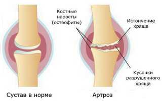 Какая диета способна облегчить жизнь пациентам при артрозе коленных суставов?