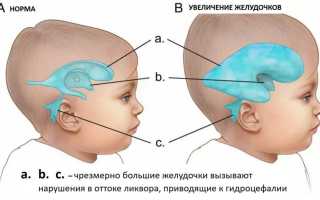 Гидроцефалия симптомы у грудных детей и лечение (личный опыт)