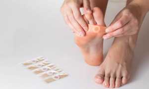 Чем удалить подошвенную бородавку