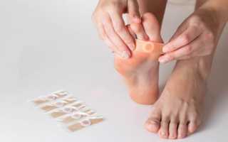 Чем удалить подошвенную бородавку