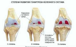 Степени и виды воспаления коленного сустава и методы их лечения