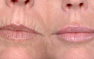 Эффективные средства для устранения морщин над верхней губой