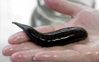 Лечебные пиявки: польза и вред нетрадиционного метода избавления от различных заболеваний