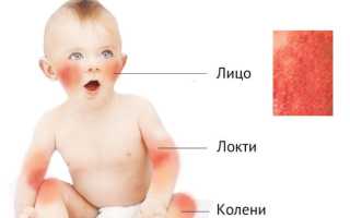 Как определить на что аллергия у ребенка