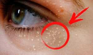 Лучшие способы борьбы с подкожными жировиками на лице