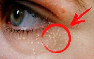 Лучшие способы борьбы с подкожными жировиками на лице