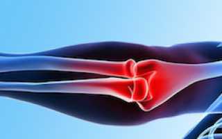 Ревматизм суставов