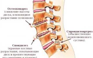 Спондилоартроз грудного отдела позвоночника