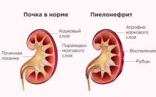 Болят почки при беременности: что делать