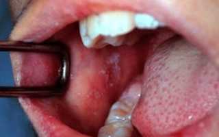 Болит горло без симптомов простуды: проблемы после выздоровления