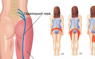 Люмбаго и ишиас — что это такое и как его лечить?
