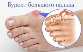 Бурсит большого пальца стопы: лечение и симптомы