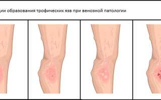 ТОП 8 препаратов-заменителей Венаруса: список дешевых аналогов