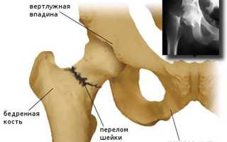 Лечение и симптомы перелома шейки бедра