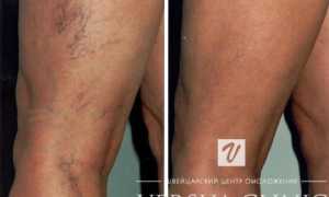 Забиты сосуды на ногах: как почистить