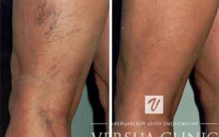 Забиты сосуды на ногах: как почистить