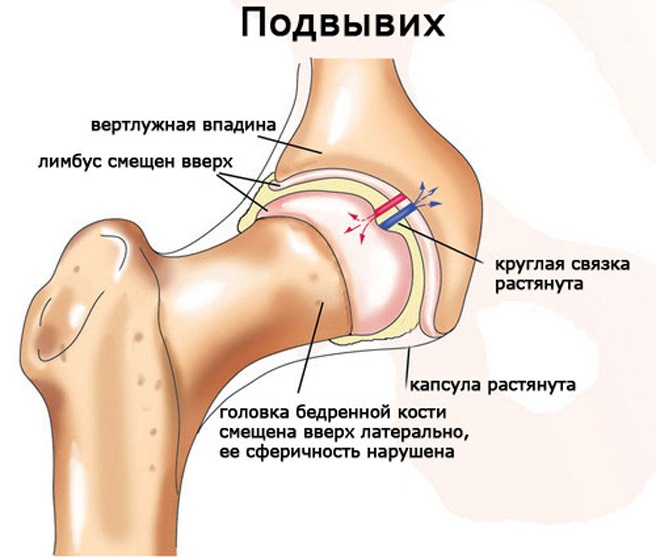 Деформация сустава