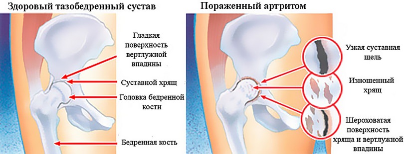Фото артрита тазовой кости