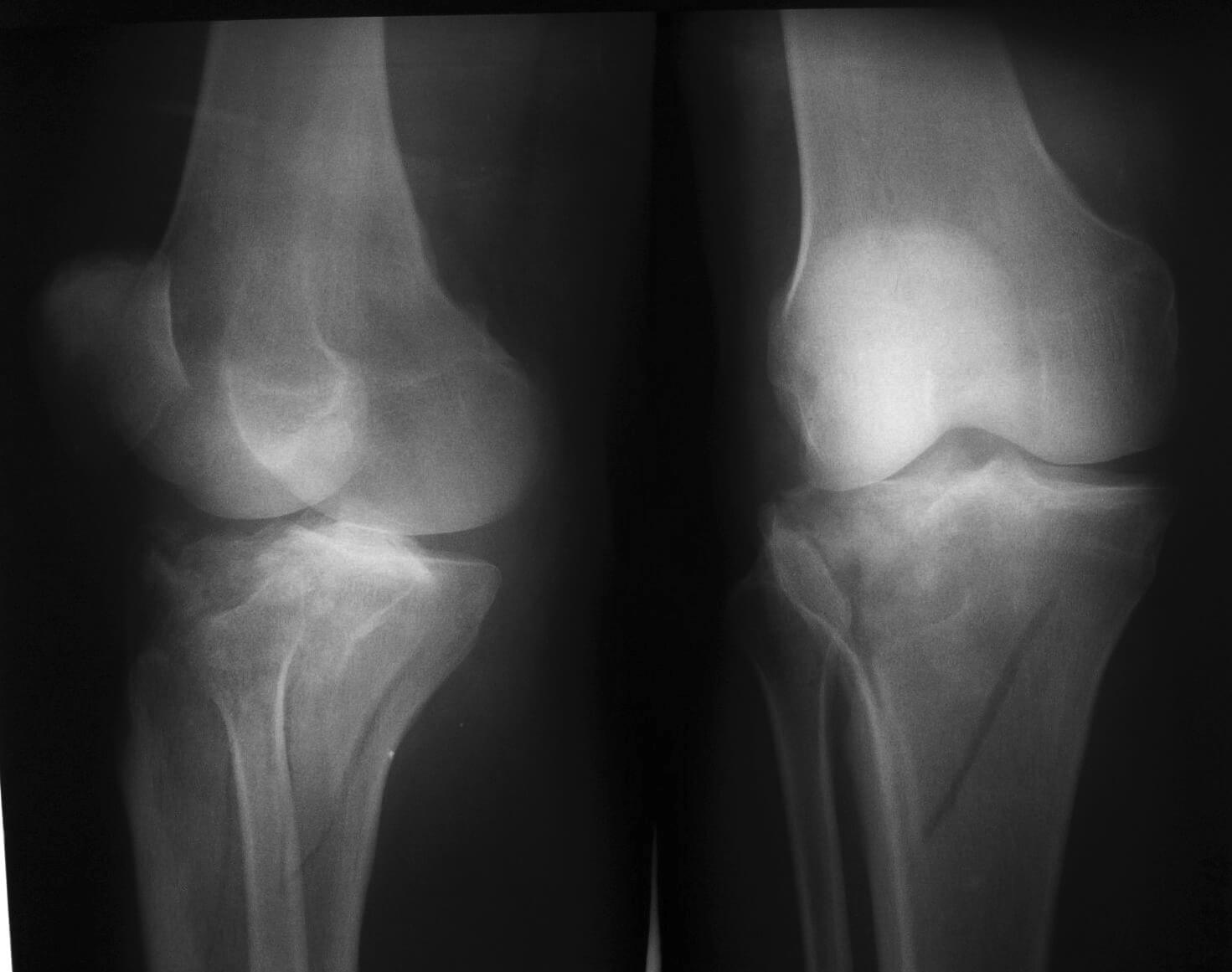 Рентгенограмма 