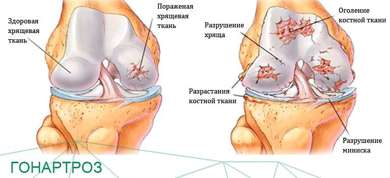 Хрящ здоровый и пораженный артрозом