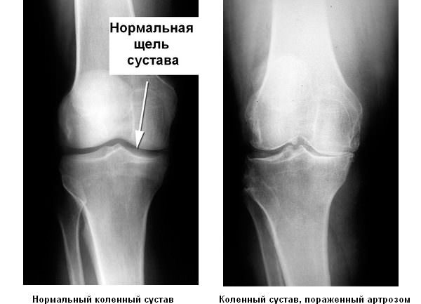 Артроз коленного сустава
